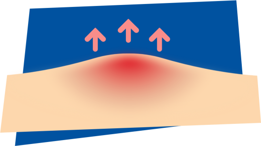 fop-flare-up